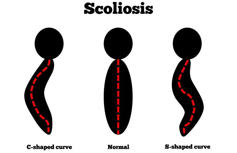 Beverly Hills, CA scoliosis treatment